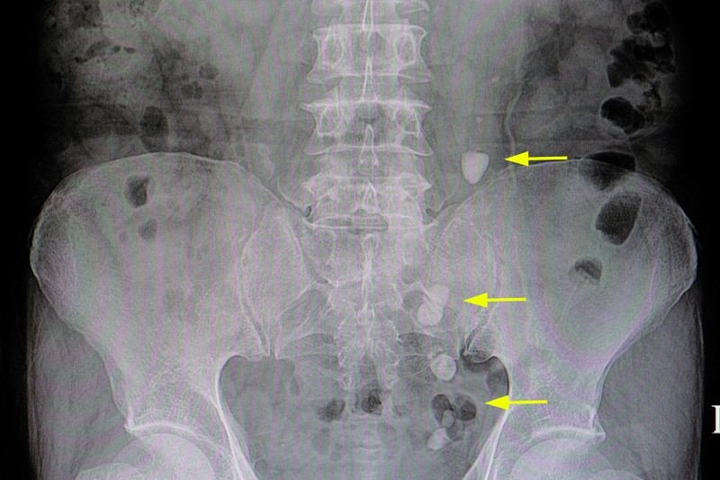 Litiasis Renal Ureteral Y Vesical Litiasis Renal Ureteral Y Vesical