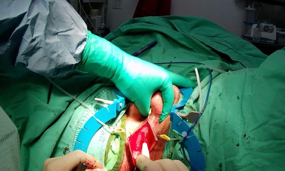 Uretroplastia