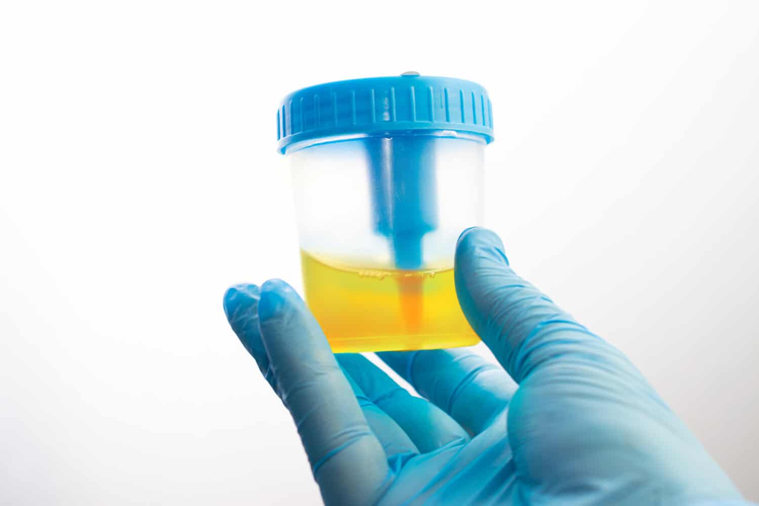 Hematuria Hematuria