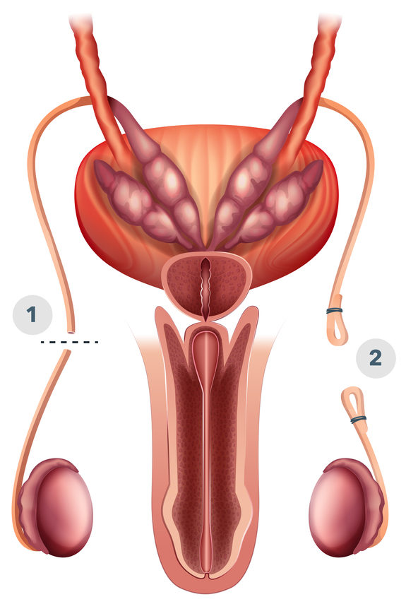Cómo Funciona La Vasectomía Reversible Cómo Funciona La Vasectomía Reversible
