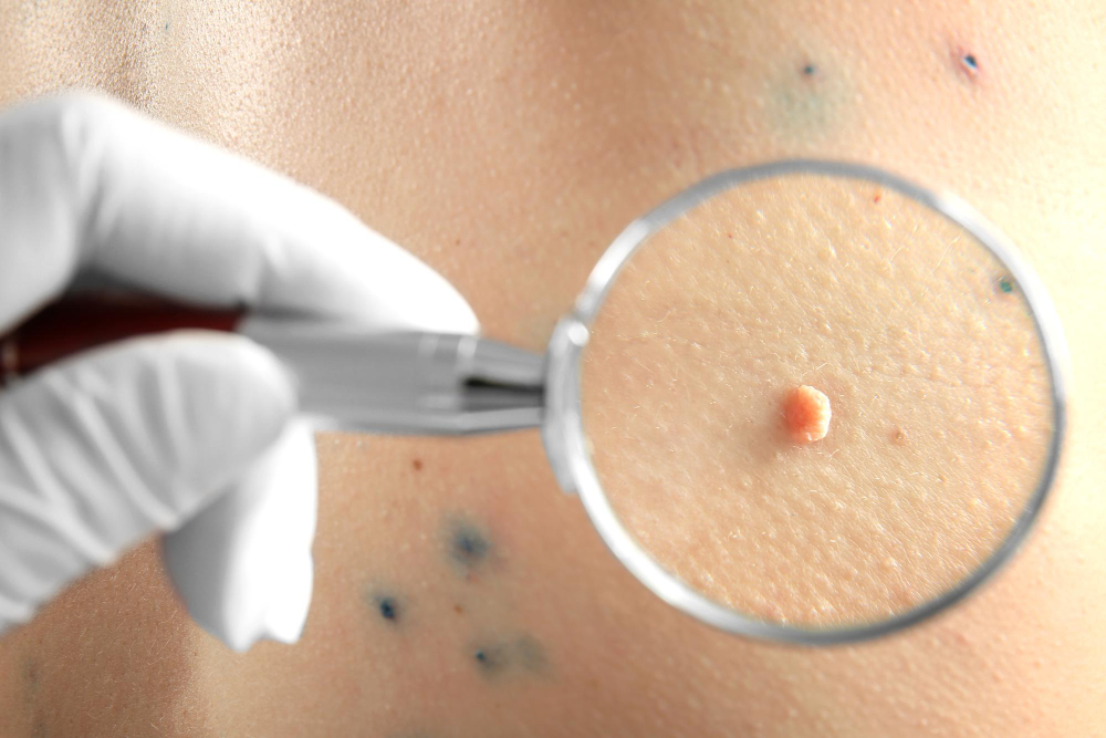 Vph Y Verrugas Genitales Vph Y Verrugas Genitales