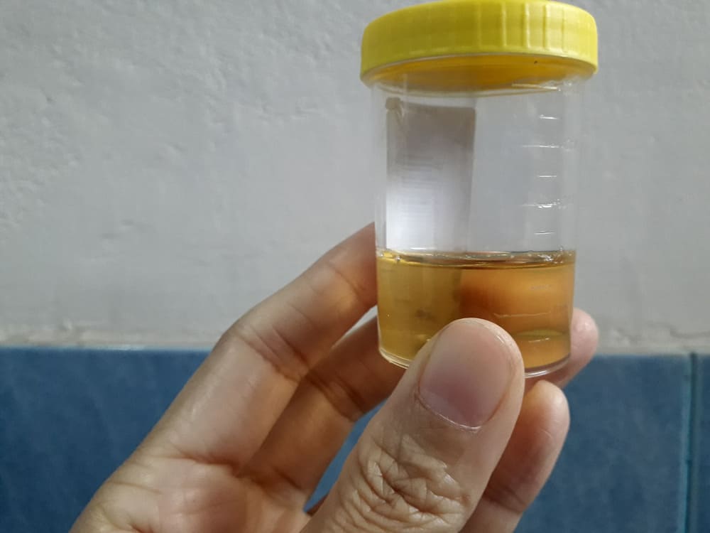 Síntomas De Las Infecciones Urinarias Recurrentes Síntomas De Las Infecciones Urinarias Recurrentes