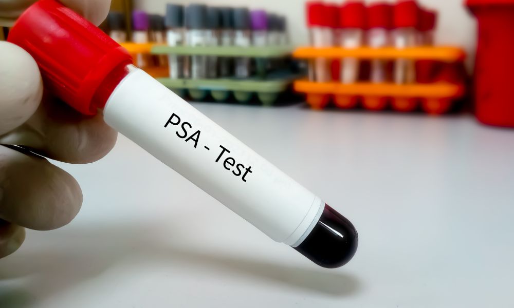 Prueba Del Antígeno Prostático Específico (Psa) Prueba Del Antígeno Prostático Específico (Psa)
