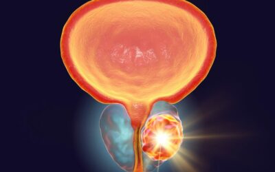 Identifica Los Síntomas De Cáncer De Próstata